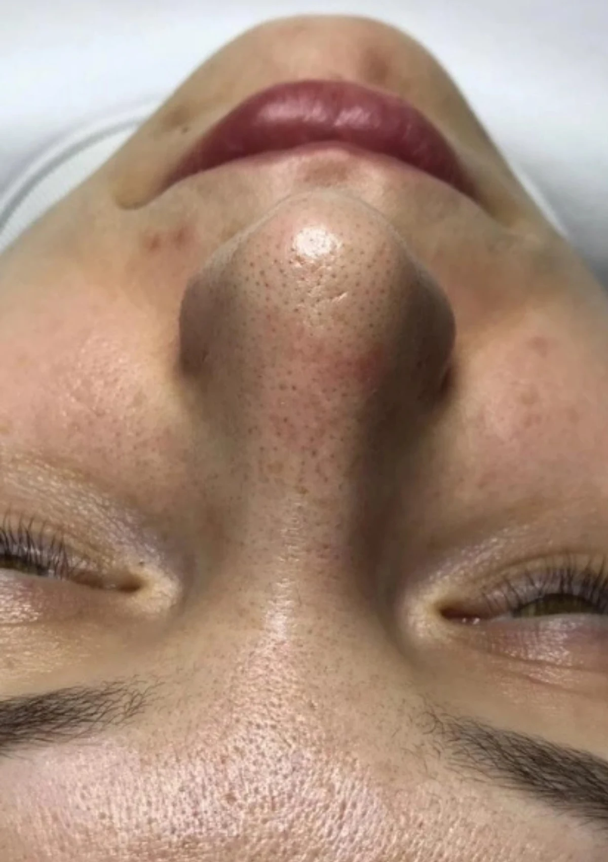 Skóra przed zabiegiem oczyszczania wodorowego